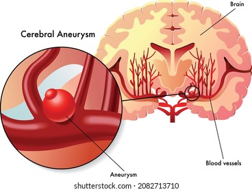 aneurysm brain cerebral aneurysm blood vessels brain cells intracranial anatomical structure biological biology