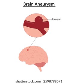 Aneurysm on the brain vector illustration