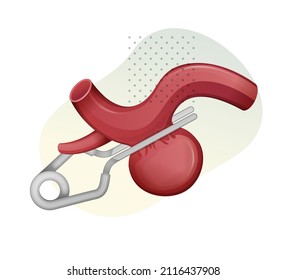 Aneurysm with Vascular Clip Procedure - Stock Illustration  as EPS 10 File