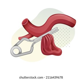 Aneurysm with Vascular Clip Procedure - Stock Illustration  as EPS 10 File