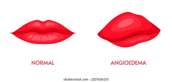 Angioedema or edema of lips, allergic swelling of lower layer of face skin or body tissue. Comparison of vector swollen and healthy upper lips or mouth, disease of lymphatic system, health care themes svg