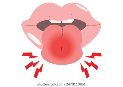 Angioedema is a rapid swelling of the deeper layers of the skin, often triggered by allergies. swelling around the tongue. It can be life-threatening if untreated.