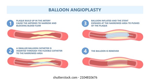 Angiography Medical Operation Angiogram Biopsy Angioplasty Stent Congenital Heart Defect Ablation CAG Arteries Plaque X-ray Flow Diagnose Diagnosis Blocked CABG Valve Atrial Attack Afib Infarction