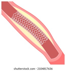 Angiography Medical Operation Angiogram Biopsy Angioplasty Stent Congenital Heart Defect Ablation CAG Arteries Plaque X-ray Flow Diagnose Diagnosis Blocked CABG Valve Atrial Attack Afib Infarction