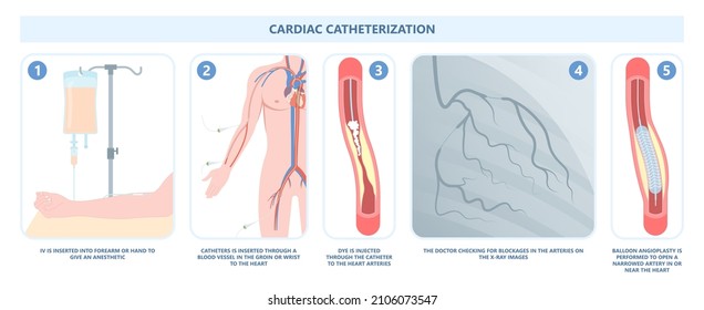 Angiography Medical Operation Angiogram Biopsy Angioplasty Stent Congenital Heart Defect Ablation CAG Arteries Plaque X-ray Flow Diagnose Diagnosis Blocked CABG Valve Atrial Attack Afib Infarction