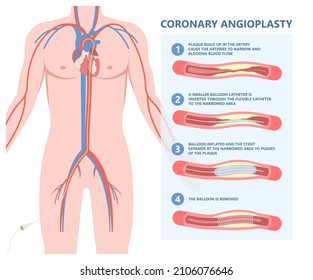 Angiography Medical Operation Angiogram Biopsy Angioplasty Stent Congenital Heart Defect Ablation CAG Arteries Plaque X-ray Flow Diagnose Diagnosis Blocked CABG Valve Atrial Attack Afib Infarction