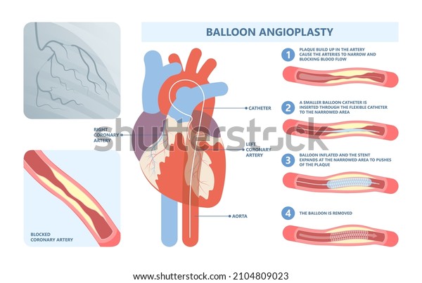 Angiography medical operation Angiogram Biopsy\
Angioplasty Stent Congenital Heart Defect Ablation CAG arteries\
plaque X-ray flow diagnose diagnosis blocked CABG valve atrial\
attack afib\
infarction