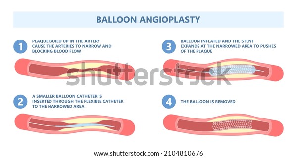 Angiography medical operation Angiogram Biopsy\
Angioplasty Stent Congenital Heart Defect Ablation CAG arteries\
plaque X-ray flow diagnose diagnosis blocked CABG valve atrial\
attack afib\
infarction