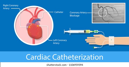 Angiography Medical Treatment Cardiac Operation Angiogram Biopsy Angioplasty Stent Congenital Heart Defect Ablation CAG Arteries Cholesterol Plaque Attack  X-ray Blood Flow Diagnose Diagnosis Blocked