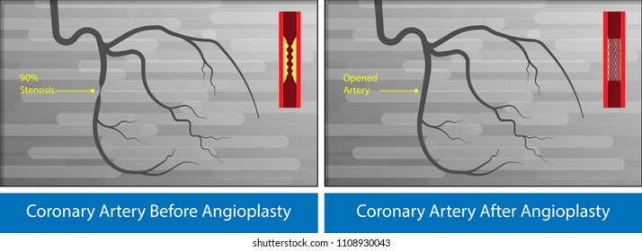 Angiography medical treatment Cardiac operation Angiogram Biopsy Angioplasty Stent Congenital Heart Defect Ablation CAG arteries cholesterol plaque attack  X-ray blood flow diagnose diagnosis blocked