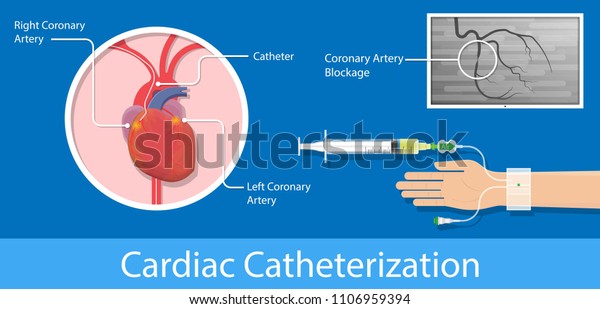 Angiography Medical Treatment Cardiac Operation Angiogram Stock Vector ...