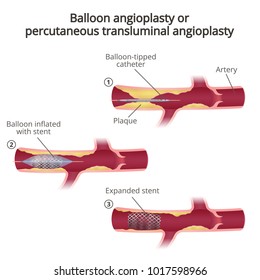 Angioplasty, balloon angioplasty and percutaneous transluminal angioplasty (PTA), stages of operation, artery with plaques in a section