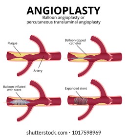 Angioplasty, Balloon Angioplasty And Percutaneous Transluminal Angioplasty (PTA), Stages Of Operation, Artery With Plaques In A Section