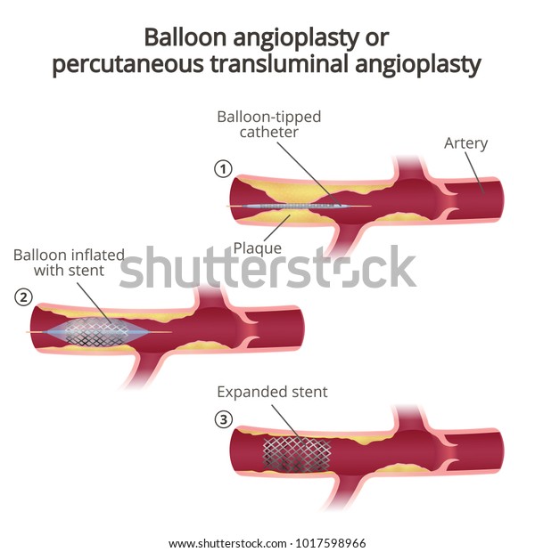 angioplasty ultra balloon
