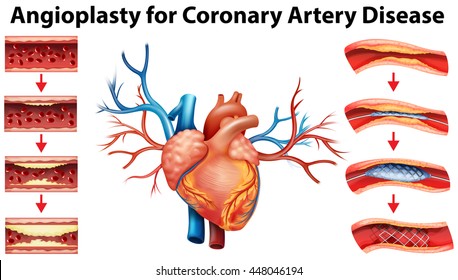 Angioplasty for coronary artery disease