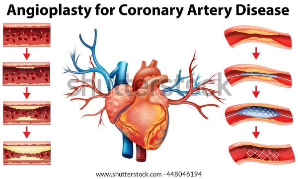 Angioplasty for coronary\
artery disease