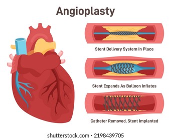 Angioplasty. Stent Delivery And Implantation. Deflated Balloon Catheter Inserted Into A Coronary Artery. Stent Expanding A Blood Vessel Wall. Flat Vector Illustration