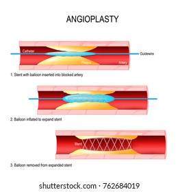 Angioplasty. Stent Implantation. Deflated balloon catheter inserted into a coronary artery narrowed by plaque. the balloon is inflated, compressing the plaque against the artery wall