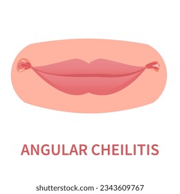 Angular cheilitis oral disease icon. Mouth corner cracks. Lips inflamation. Perleche symptoms. Stomatitis outbreak. Medical concept. Vector illustration isolated on white.