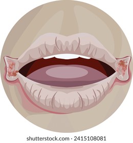 angular stomatitis with dry and cracked lips