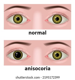 anisocoria. abnormally dilated pupil of the eye. Ophthalmic diseases. Medical poster. preliminary illustration