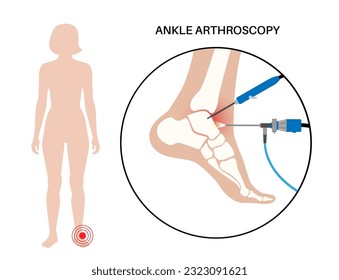 Ankle arthroscopy procedure. Feet joint minimally invasive surgery concept. Arthroscope and arthroscopic instrument. Foot treatment, leg pain and inflammation. Anatomical x ray vector illustration