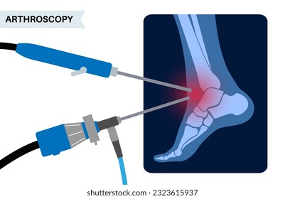 Ankle arthroscopy procedure. Feet joint minimally invasive surgery concept. Arthroscope and arthroscopic instrument. Foot treatment, leg pain and inflammation. Anatomical x ray vector illustration