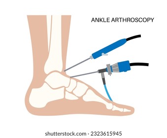 Ankle arthroscopy procedure. Feet joint minimally invasive surgery concept. Arthroscope and arthroscopic instrument. Foot treatment, leg pain and inflammation. Anatomical x ray vector illustration