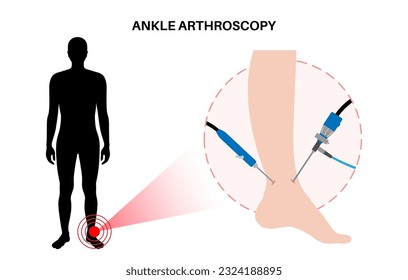 Ankle arthroscopy procedure. Feet joint minimally invasive surgery concept. Arthroscope and arthroscopic instrument. Foot treatment, leg pain and inflammation. Man in clinic flat vector illustration