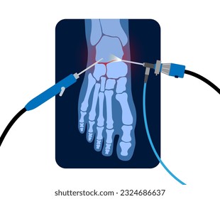 Ankle arthroscopy procedure. Feet joint minimally invasive surgery concept. Arthroscope and arthroscopic instrument. Foot treatment, leg pain and inflammation. Anatomical x ray vector illustration