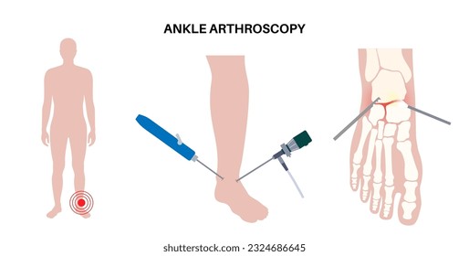 Ankle arthroscopy procedure. Feet joint minimally invasive surgery concept. Arthroscope and arthroscopic instrument. Foot treatment, leg pain and inflammation. Anatomical x ray vector illustration