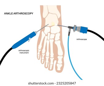 Ankle arthroscopy procedure. Feet joint minimally invasive surgery concept. Arthroscope and arthroscopic instrument. Foot treatment, leg pain and inflammation. Anatomical x ray vector illustration