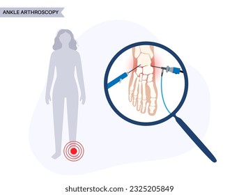 Arthroskopie des Knöchels. Füttern Sie das minimal-invasive Chirurgie-Konzept. Arthroskop und arthroskopisches Instrument. Fußbehandlung, Beinschmerzen und Entzündungen. Anatomische Röntgenvektorgrafik