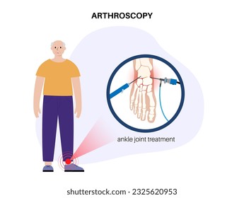 Ankle arthroscopy procedure. Feet joint minimally invasive surgery, old age man in clinic. Arthroscope and arthroscopic instrument. Foot treatment, leg pain and inflammation flat vector illustration