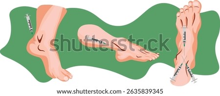 An Ankle Block is a regional anesthesia technique used to numb the foot and ankle for surgical procedures by injecting local anesthetic around the tibial, sural, deep peroneal, and saphenous nerves