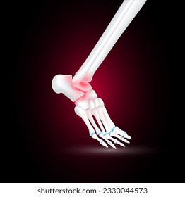 Ankle bone foot traumas and arthritis joint cartilage side on black background. Human skeleton anatomy healthy. Medical health care science concept. Realistic 3D vector.