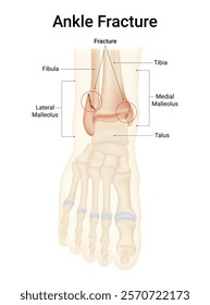 Ankle Fracture (Broken Ankle) Causes