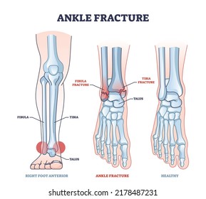 Ankle fracture and right foot anterior trauma medical view outline diagram. Labeled educational scheme with anatomical comparison for healthy and fractured bones vector illustration. Leg tibia injury