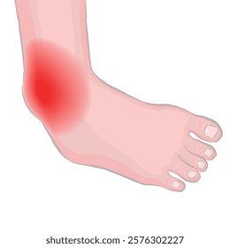 ankle fracture. Vector medical illustration. Image of a foot with a dislocation