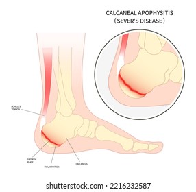 ankle injury broken bone The sever's disease painful tendon tear and haglund's Flatfeet exercise Supination with Pronation obesity of trauma