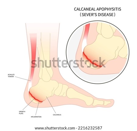 ankle injury broken bone The sever's disease painful tendon tear and haglund's Flatfeet exercise Supination with Pronation obesity of trauma