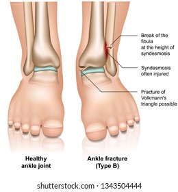 Ankle joint fracture Type B medical vector illustration on white background