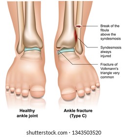 Ankle joint fracture Type c medical vector illustration on white background