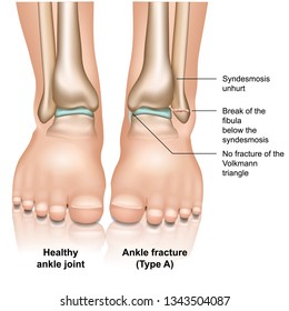 Ankle joint fracture Type A medical vector illustration on white background