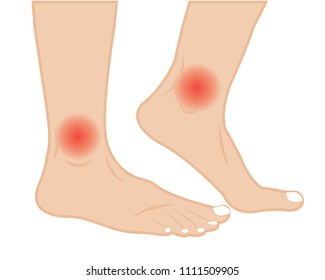 Ankle joint pain  treatment  vector illustration.  