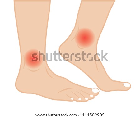 Ankle joint pain  treatment  vector illustration.  