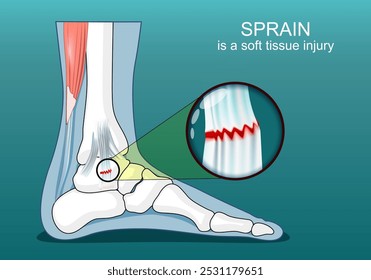 Ankle ligament sprain. Close-up of a soft tissue ligament injury. Foot joint. Isometric flat illustration. Vector poster