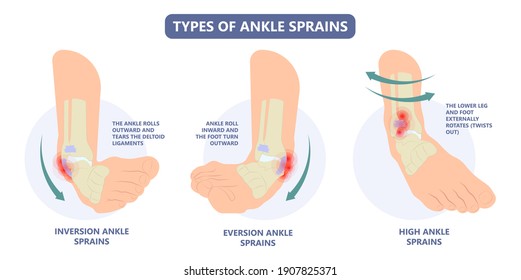 Ankle sprain with the ligament tear and injury