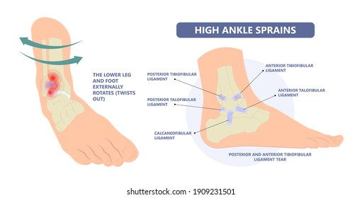 Ankle sprain with the ligament tear and injury