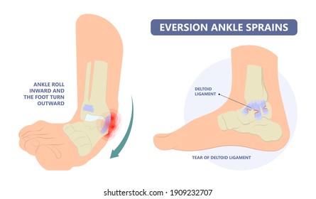 Ankle sprain with the ligament tear and injury